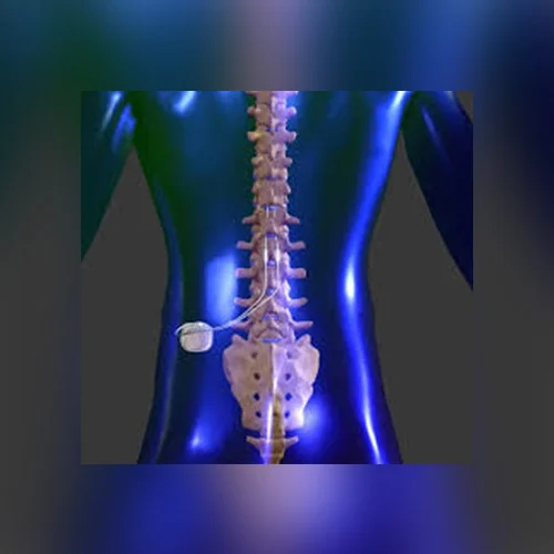 https://acpsc.com/site/wp-content/uploads/2021/02/Spinal-Cord-Stimulation.jpg.webp